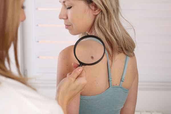What Are Traditional Skin Lesion Removal Methods Newport?