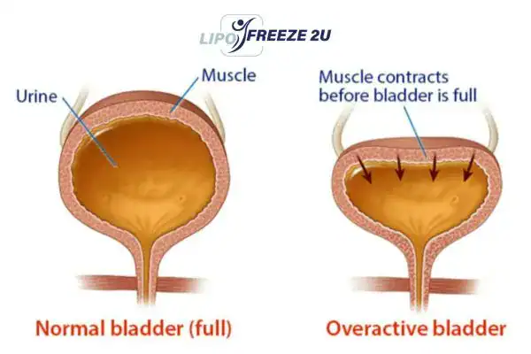 diagram of overactive bladder treatment Newport