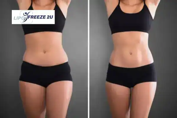 How Can LIPO FREEZE 2U Support Your Post-Pregnancy Body Recovery Newport?