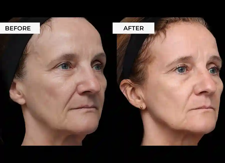 How Many RF Microneedling Sessions Will You Need to See a Difference Newport?