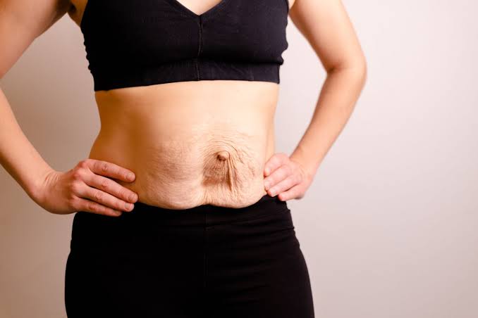 Is Surgery Really the Only Way to Repair Diastasis Recti Newport?
