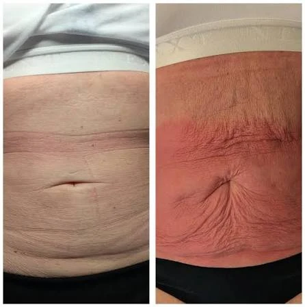 How Does RF Microneedling Improve Crepey, Thin and Uneven Skin Texture Newport?
