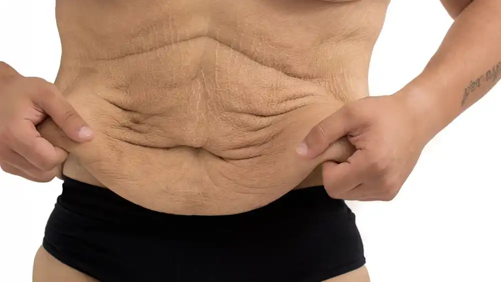 Why Does Weight Loss Medication Leave Some People With Loose or Sagging Skin Newport?